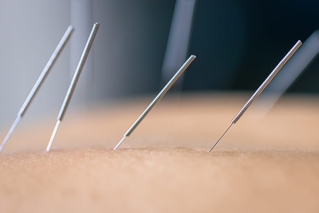 Akupunktura – na czym polega?